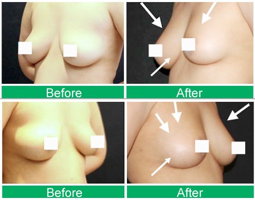 自體脂肪隆乳改善產後下垂乳房