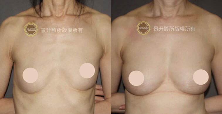 自體脂肪隆乳手術前後分對比（偏瘦女性）