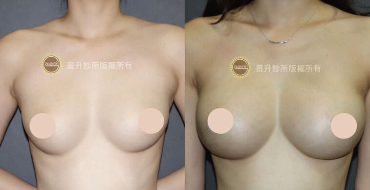 自體脂肪隆乳手術前後分對比（胸型改善）