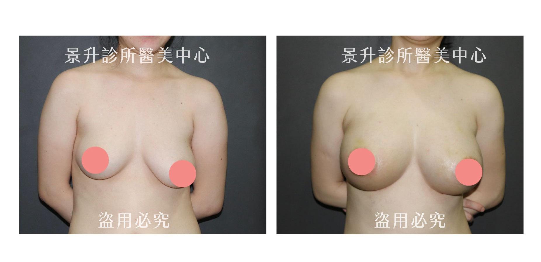 產後乳房下垂與不對稱成功改善案例