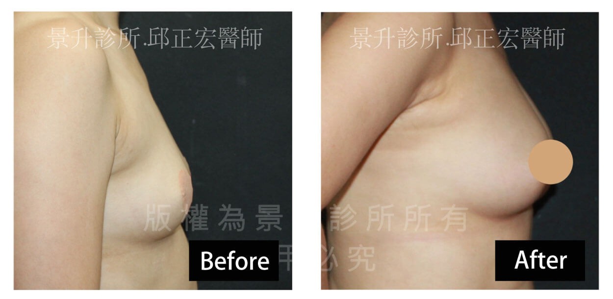 自體脂肪隆乳改善產後乳房下垂變形-1