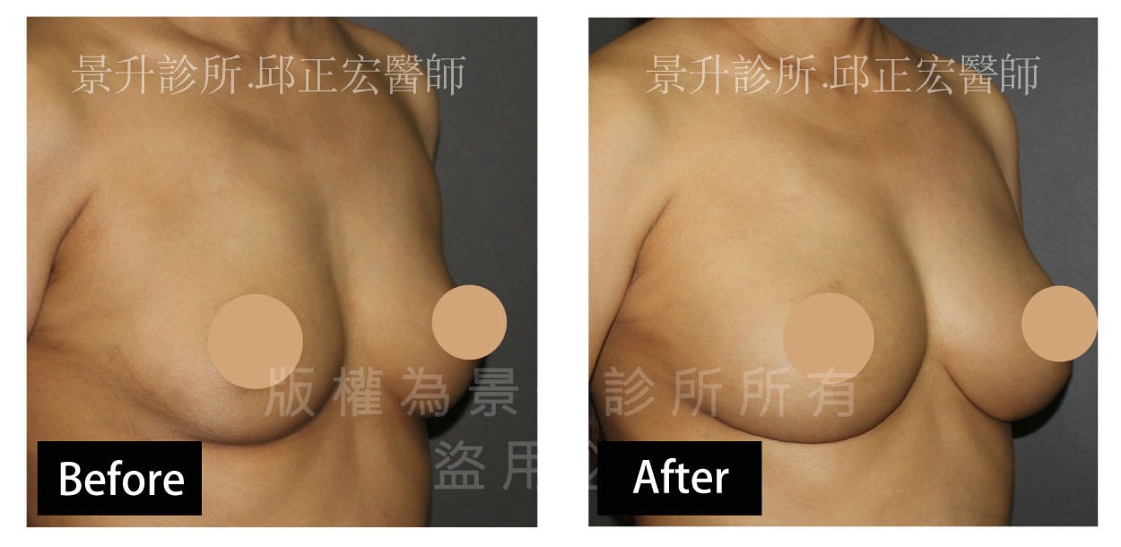自體脂肪隆乳改善產後乳房下垂變形-3