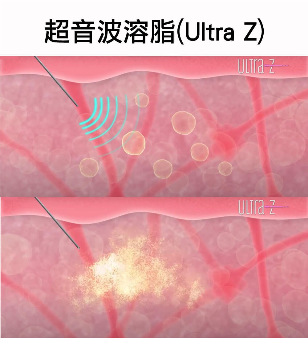 超音波抽脂Ultra Z解說 