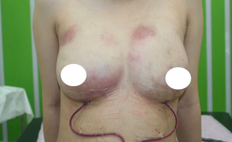 自體脂肪隆乳手術脂肪壞死加上細菌感染，病患胸部呈現紅腫