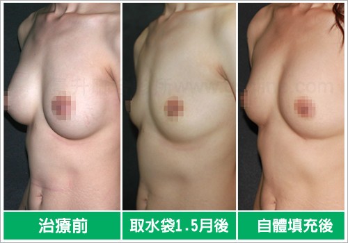 義乳拆除用重做自體脂肪隆乳改善