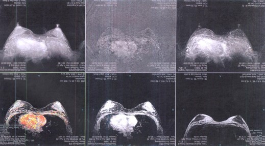 自體脂肪隆乳手術後採用MRI檢測硬塊或鈣化