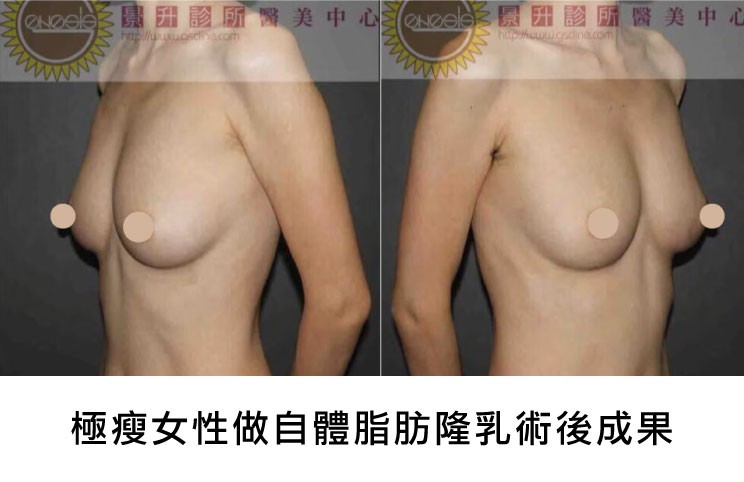 極瘦女性做自體脂肪隆乳術後照