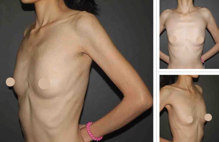 極瘦女性做自體脂肪隆乳術前照