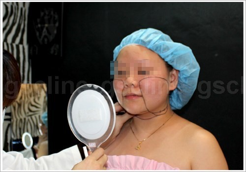 雷射溶脂瘦小臉手術過程