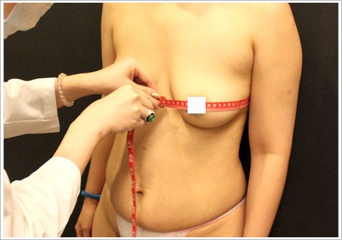 自體脂肪隆乳前測量記錄