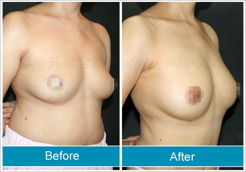 自體脂肪隆乳術後乳房前後對照