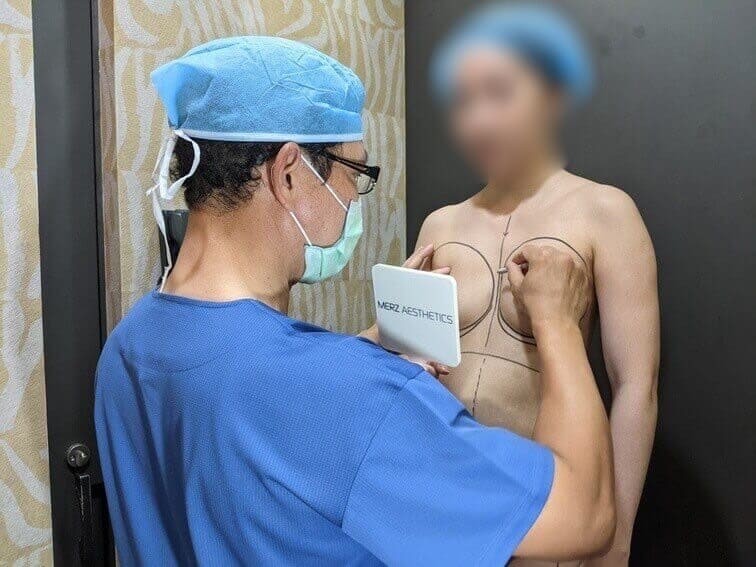 自體脂肪隆乳術前醫師畫線