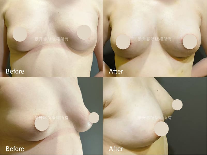自體脂肪隆乳術後胸型對比