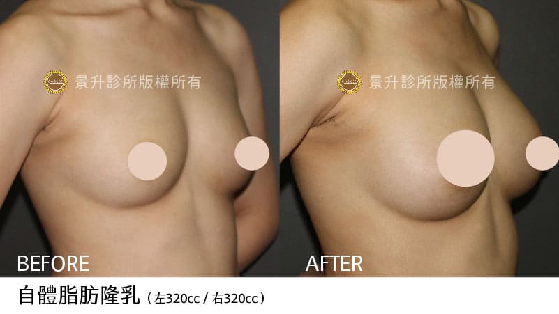 自體脂肪隆乳改善胸部美型