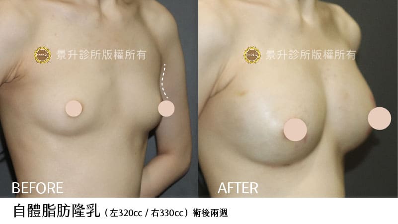自體脂肪隆乳明顯改善上胸凹陷問題