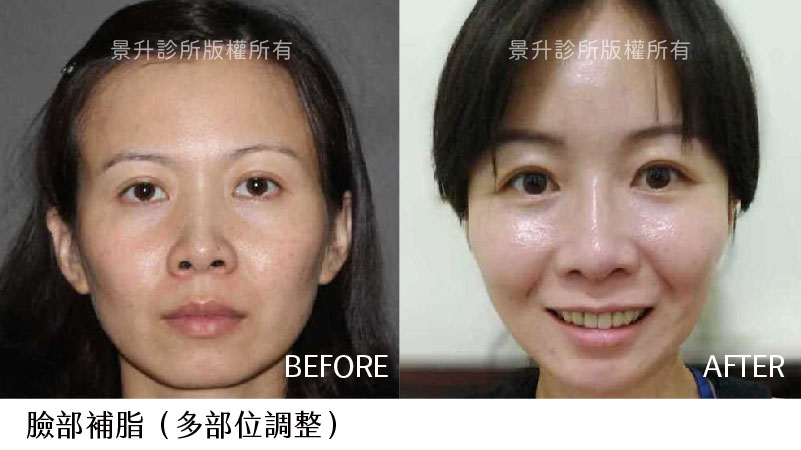 脂肪補臉改善凹陷更顯年輕