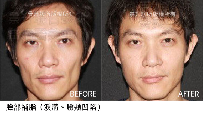 男性脂肪移植改善臉頰凹陷