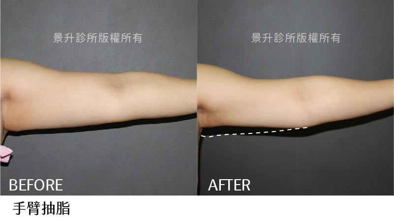 手臂抽脂案例主要針對上臂肥胖改善