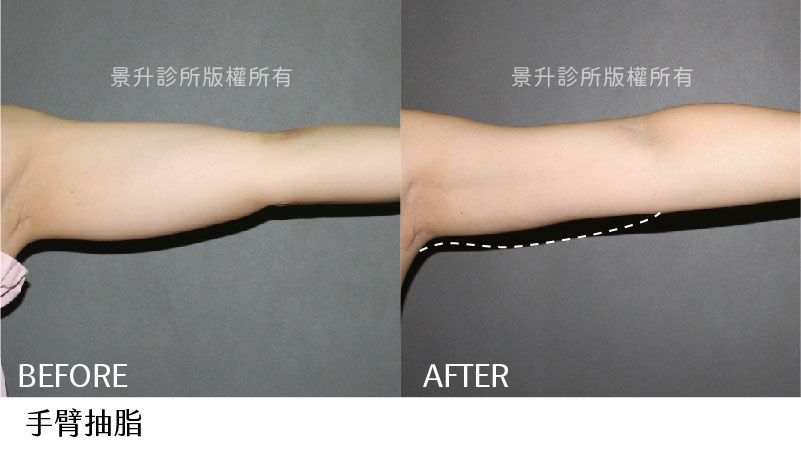 手臂抽脂案例改善局部難瘦脂肪