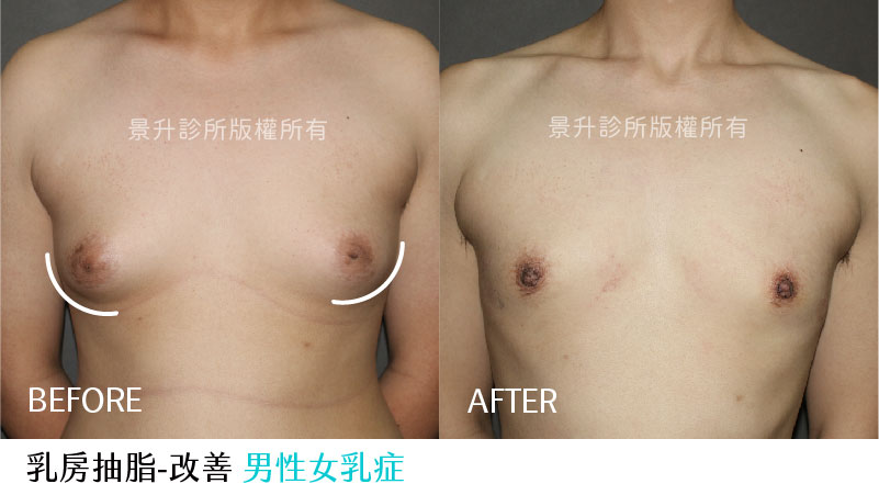 乳房局部抽脂改善男性乳房突出