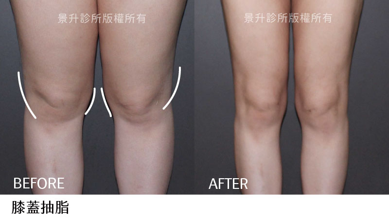 膝蓋抽脂美化大小腿連接線條