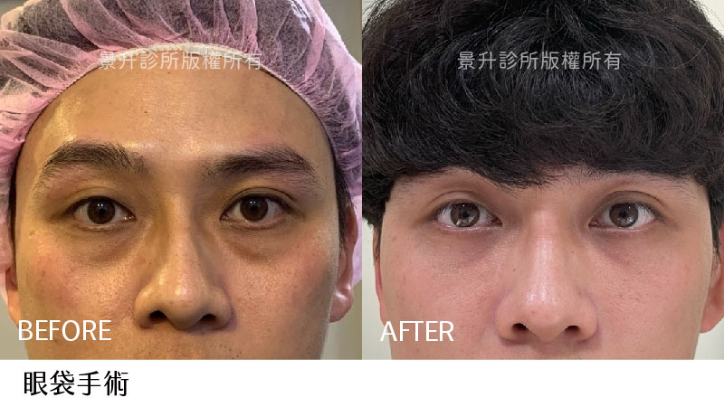 內開式眼袋手術改善浮腫眼袋