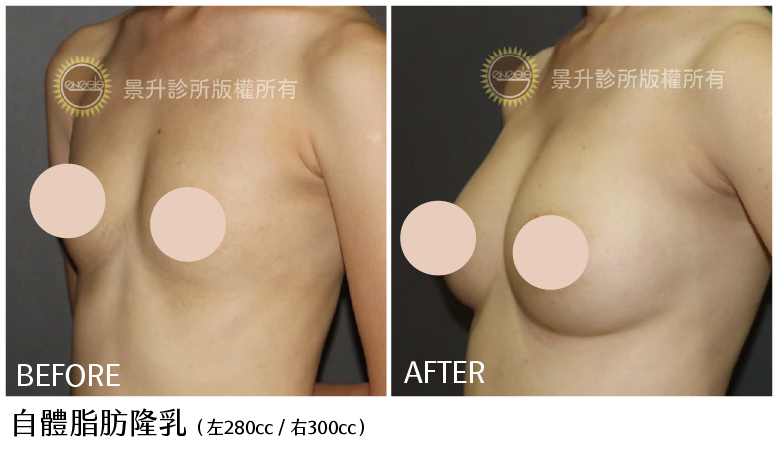 自體脂肪隆乳前後對比圖-2