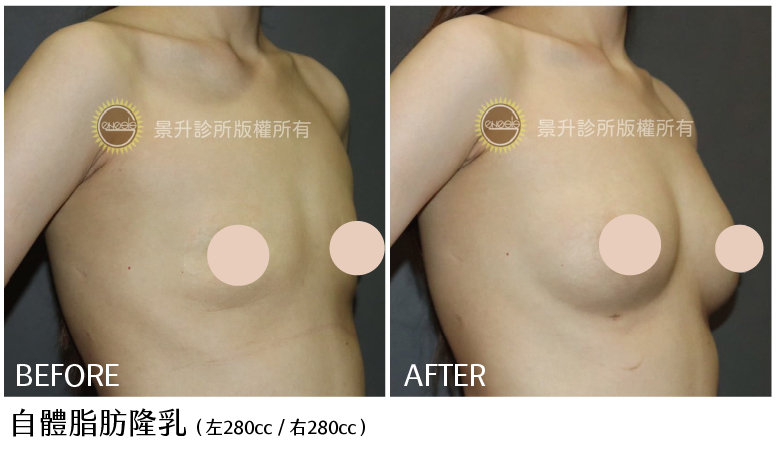 自體脂肪隆乳前後對比圖-3