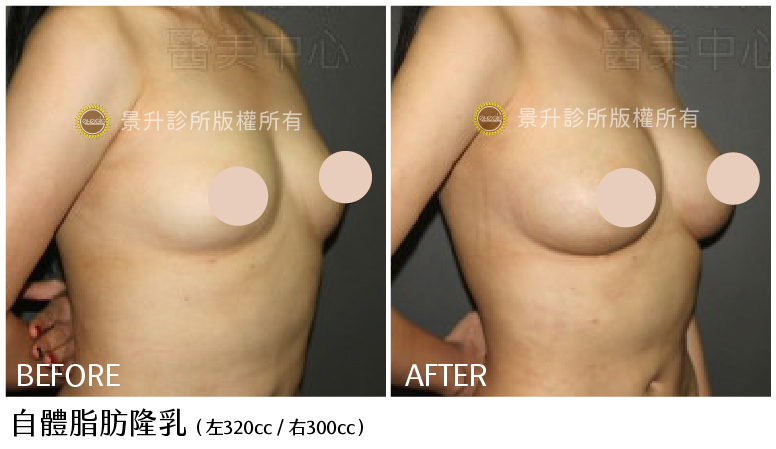 自體脂肪隆乳前後對比圖-4