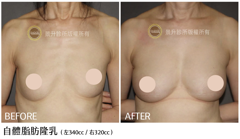 自體脂肪隆乳前後對比圖-5