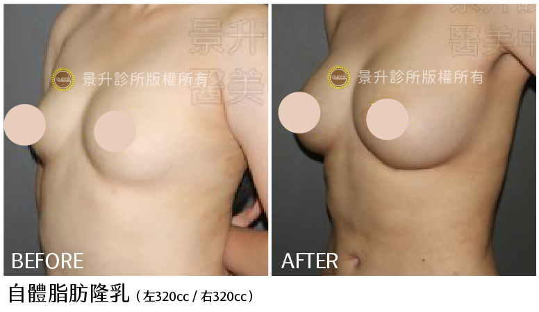 自體脂肪隆乳前後對比圖-7