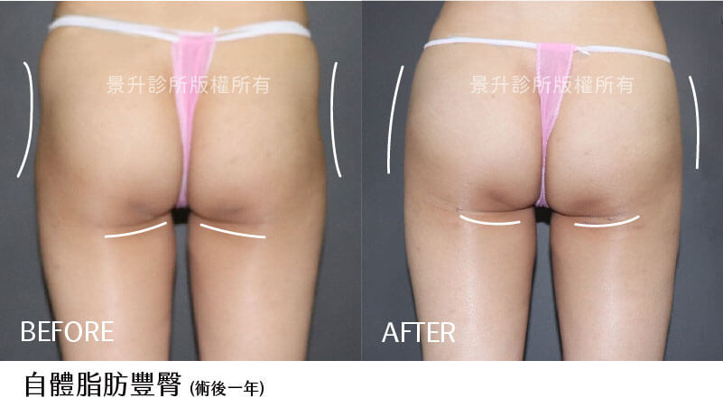 fattransfer-breech-case-1 fattransfer-breech-case-1