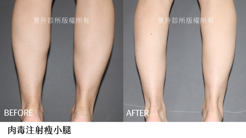 calf-slimming-1 calf-slimming-1