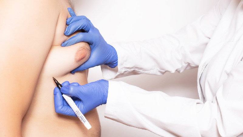 gynecomastia-1 gynecomastia-1