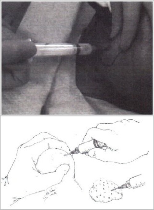 adsc-induration-01 adsc-induration-01