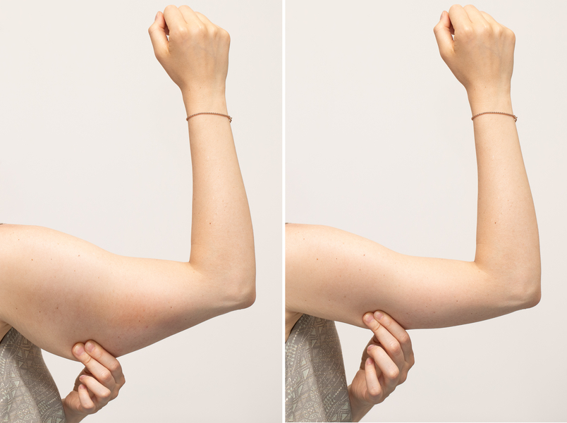 arm-liposuction-5