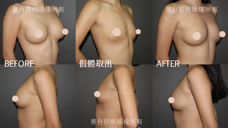 breast-reconstruction-case-1 breast-reconstruction-case-1