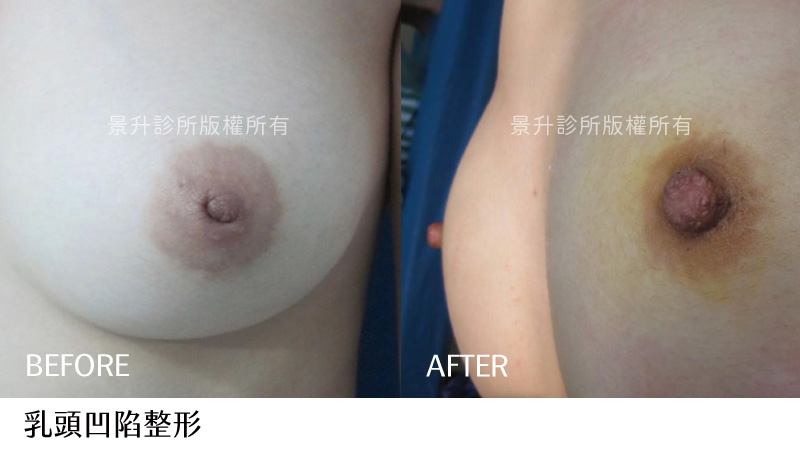 crater-nipple-case-5