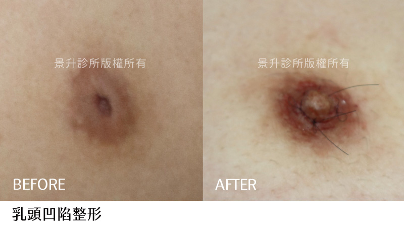 crater-nipple-case-6