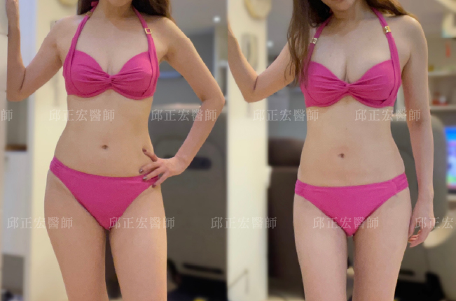fat-transfer-to-breast-case-1 自體脂肪隆乳泳裝對比