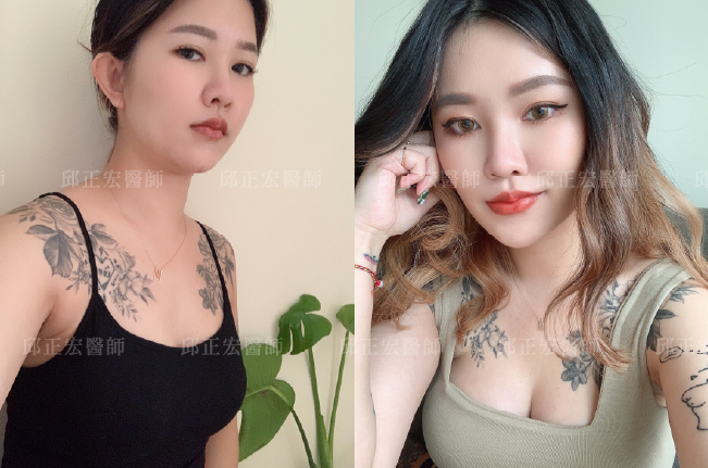 fat-transfer-to-breast-case-2 自體脂肪隆乳發發對比