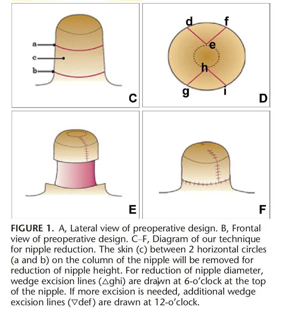 nipple-reduction-photo-figure-2 nipple-reduction-photo-figure-2