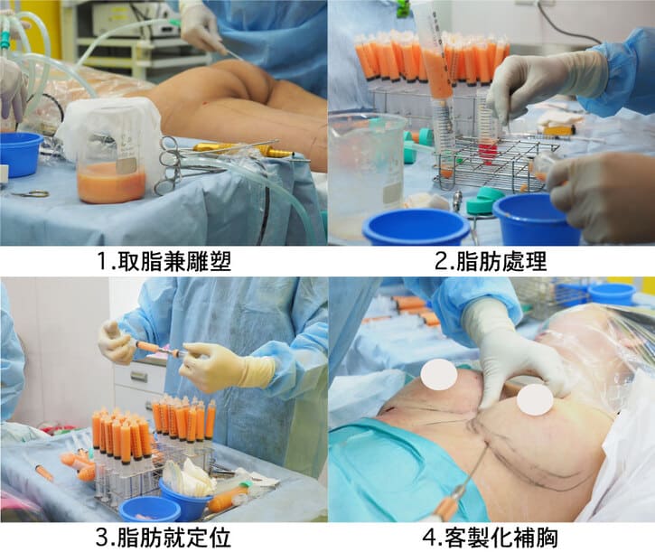 自體脂肪隆乳流程