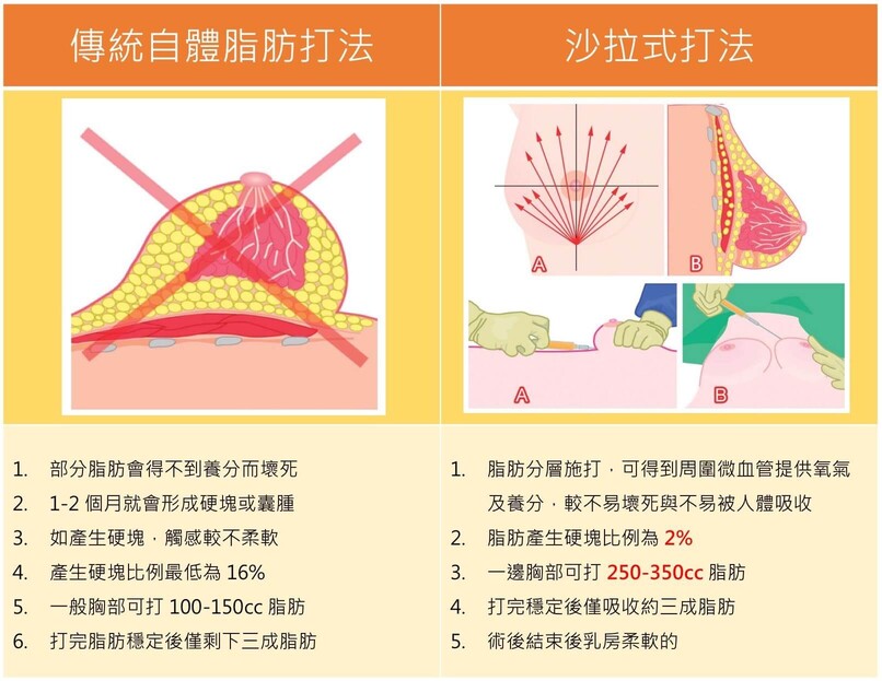 自體脂肪打法差異（沙拉式打法）