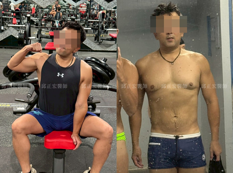 100kg-story-3 胃肉毒減重治療後變化