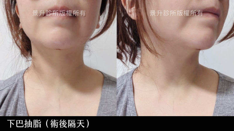 chin-lipo-case-1 chin-lipo-case-1