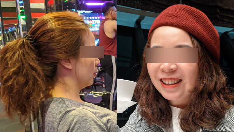 double-chin-surgery-1 double-chin-surgery-1