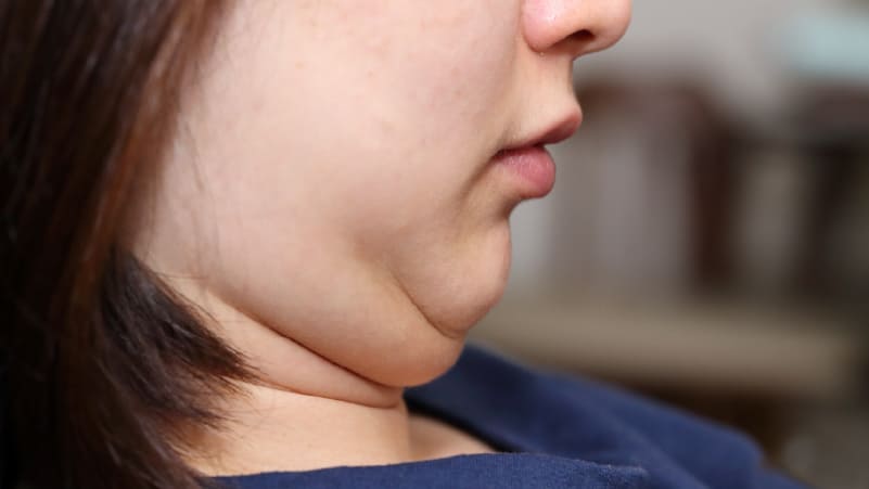 double-chin-surgery-3 double-chin-surgery-3