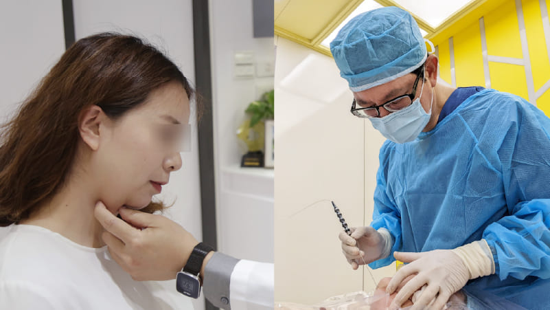 double-chin-surgery-4 double-chin-surgery-4