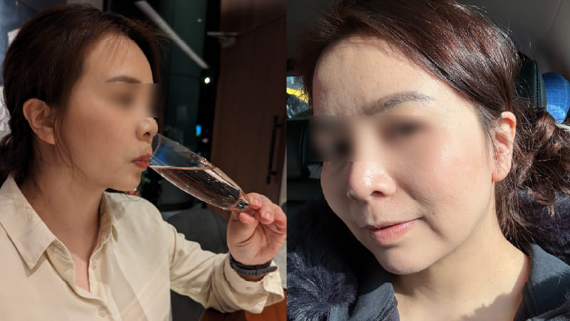 double-chin-surgery-5 double-chin-surgery-5